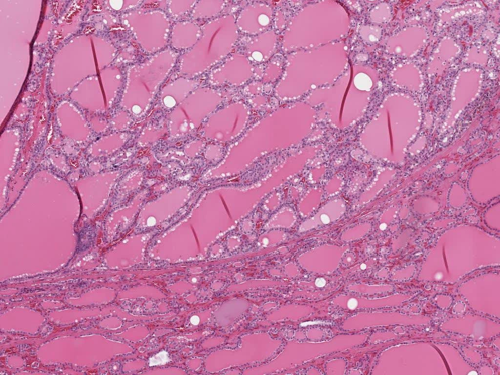 Thyroid micrograph with round follicles filled with colloid