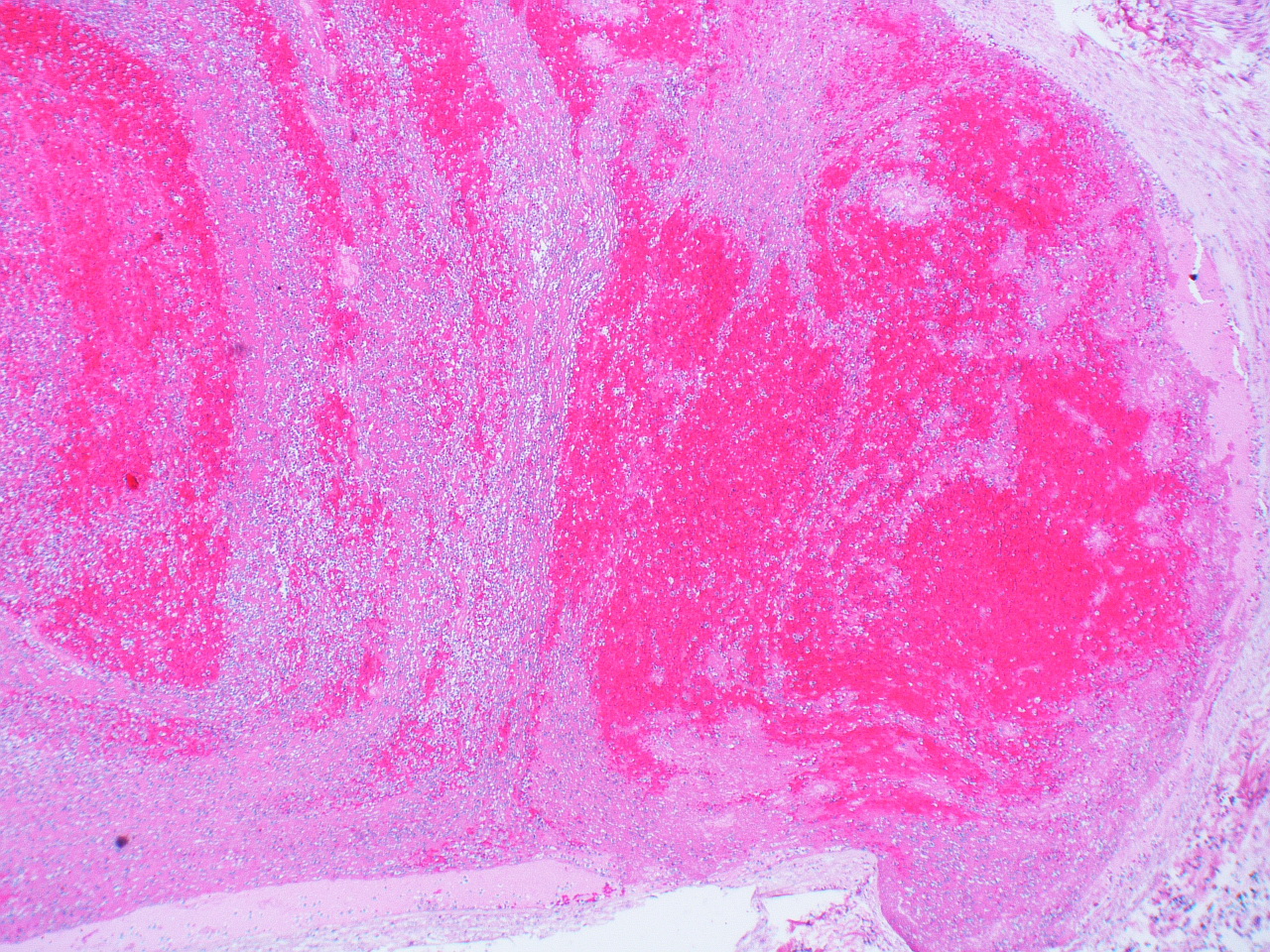 Visual journey cover: Antiphospholipid syndrome: the antibody behind clots in the wrong places