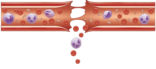 A torn blood vessel, with red blood cells spilling out of the opening