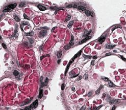 Terminal villi from a healthy placenta stained with hematoxylin and eosin: purple nuclei and capillaries filled with red blood cells