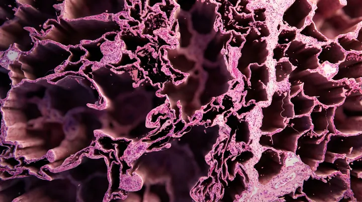 Emphysema: when alveoli lose their walls
