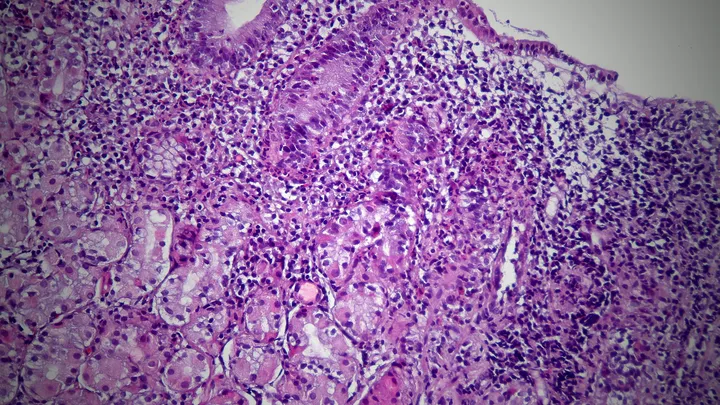 Gastritis por H. pylori: así cambia el estómago