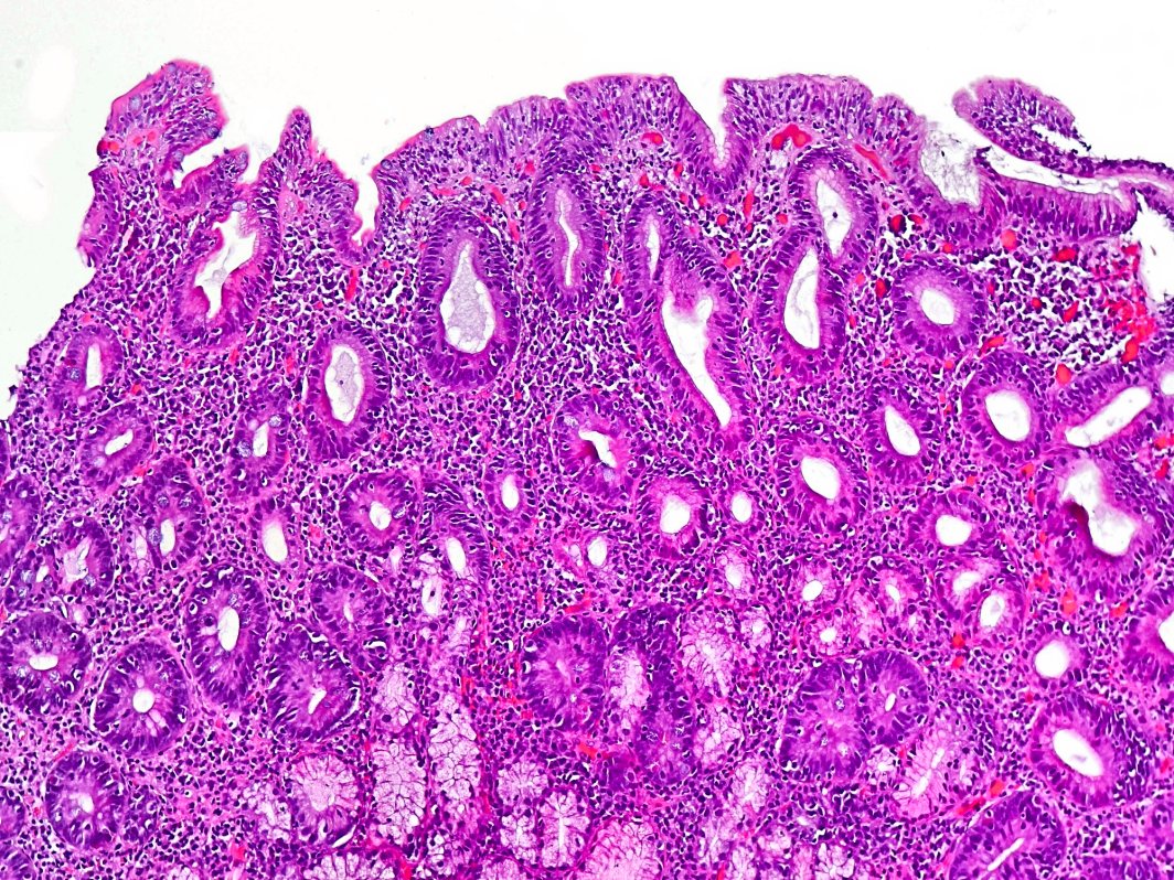 Duodenum with celiac disease under the microscope