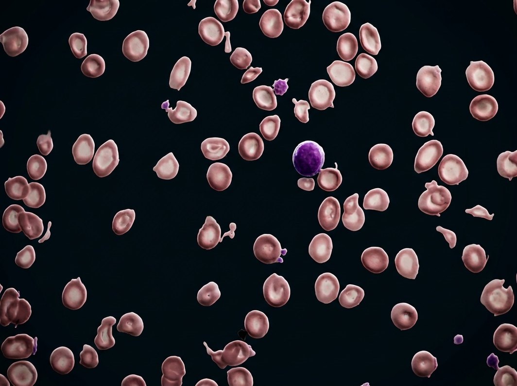 Iron-deficient blood under the microscope