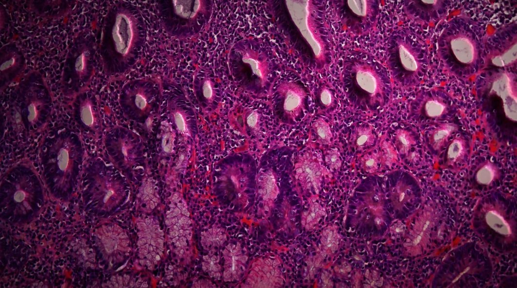 Duodenum with celiac disease under the microscope