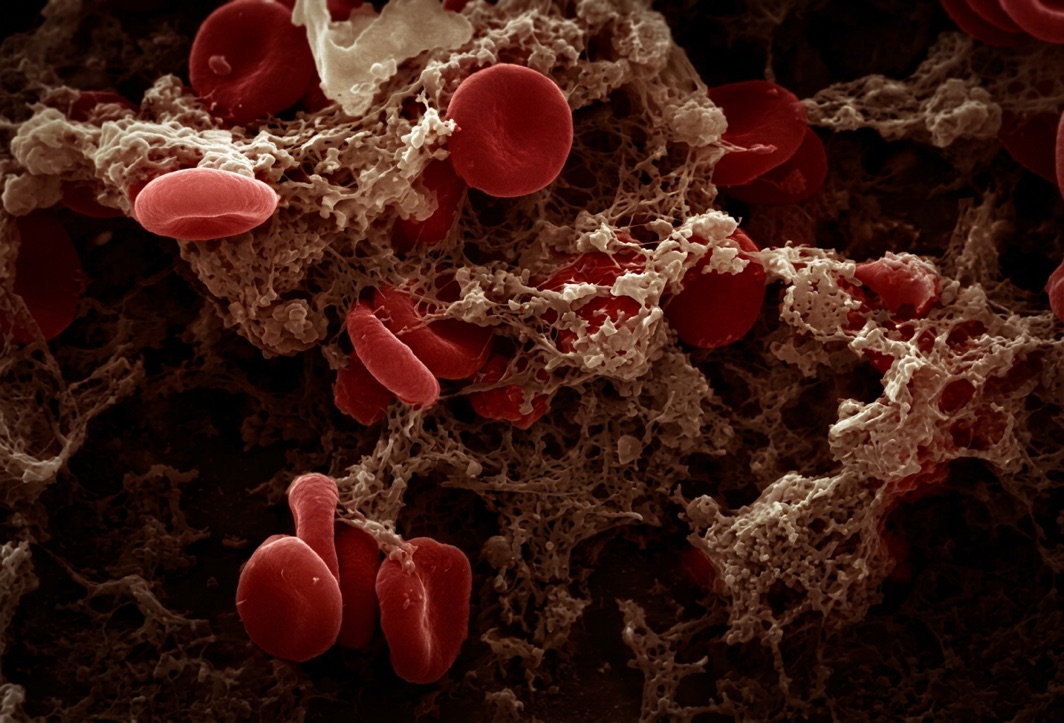 Red blood cells trapped in a fibrin mesh, seen under an electron microscope