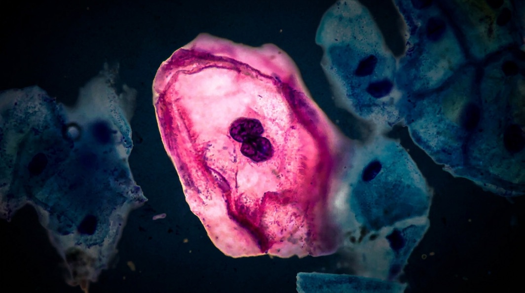 A koilocyte in a cervical cytology sample: the footprint of the papillomavirus under the microscope