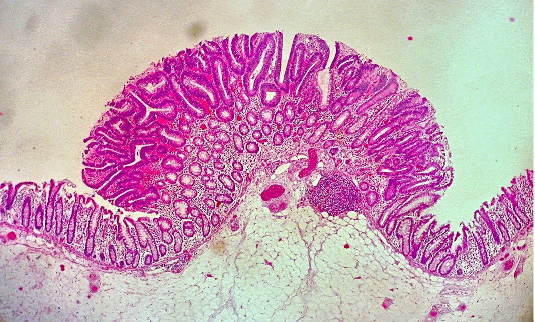 Tubular adenoma of the colon under the microscope