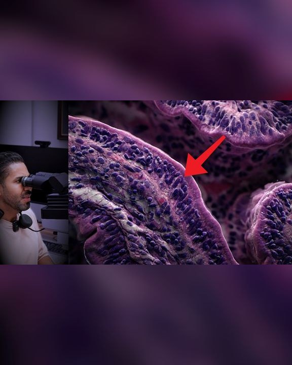 Video thumbnail: Gluten and celiac disease: he was still exhausted while his intestine was being damaged