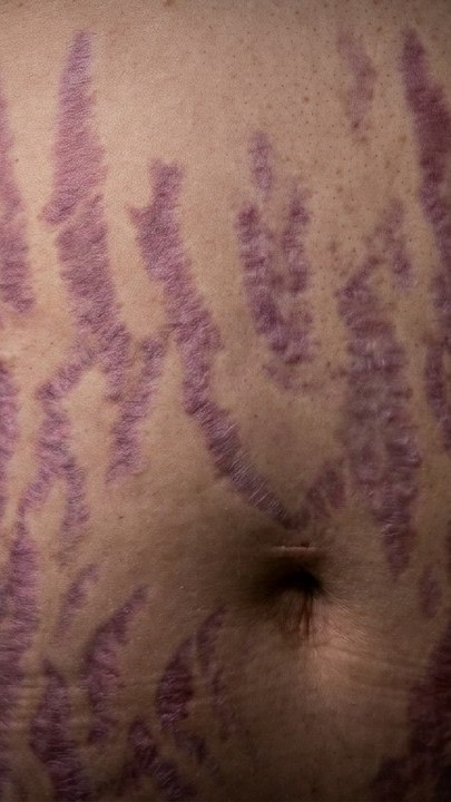 Video thumbnail: Round face, belly and purple stretch marks: too much cortisol | CUSHING SYNDROME