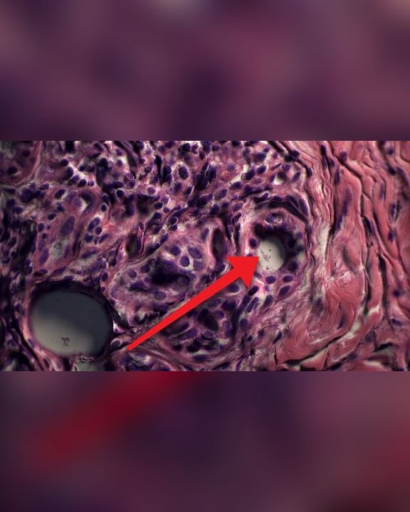 Video thumbnail: Syphilis: the infection that disguises itself as almost any disease
