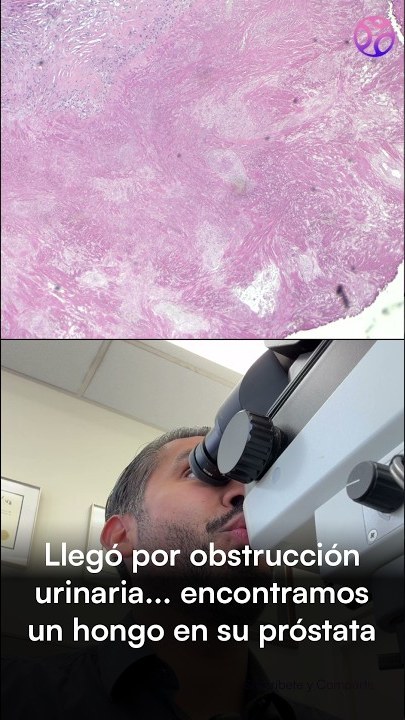 Video thumbnail: He came in with a urinary obstruction .. and we found a fungus in his prostate