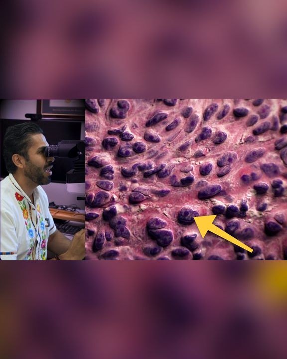 Video thumbnail: They thought their mole was changing because they scratched it... but it was melanoma | NEVUS VS MELANOMA