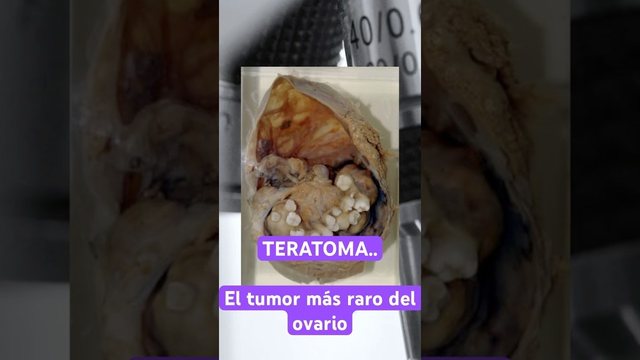 Video thumbnail: The strangest ovarian tumor