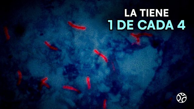 Video thumbnail: Tuberculosis: he thought his cough was COPD .. we confirmed it under the microscope