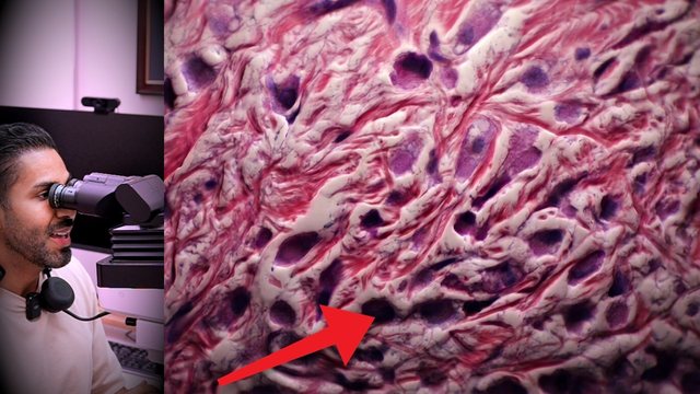 Video thumbnail: Breast cancer: it returned in the skin, where no one was looking