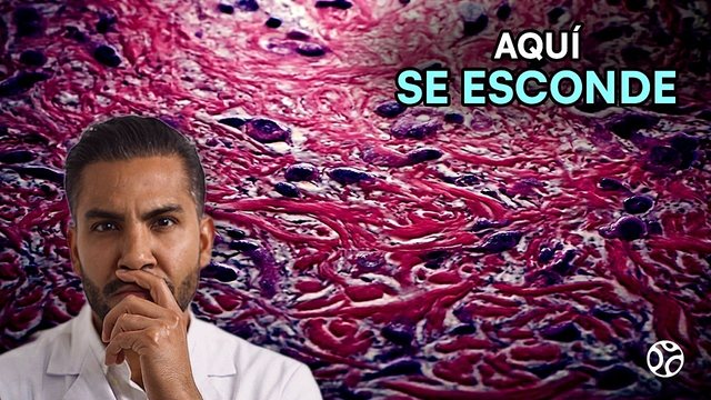 Video thumbnail: Breast cancer: it returned in the skin, where no one was looking