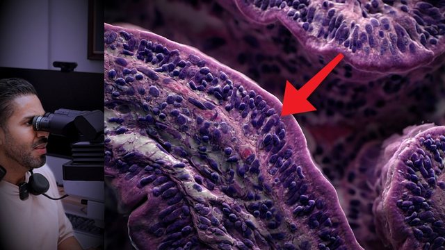 Video thumbnail: Gluten and celiac disease: he was still exhausted while his intestine was being damaged