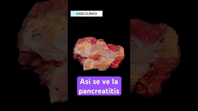 Video thumbnail: Acute pancreatitis: what a pancreas digesting itself looks like