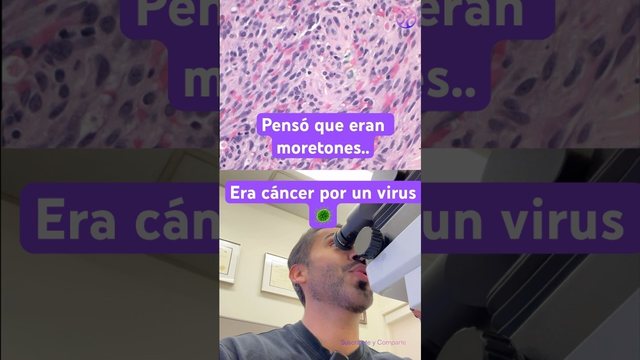 Video thumbnail: He thought they were bruises .. it was cancer caused by a virus