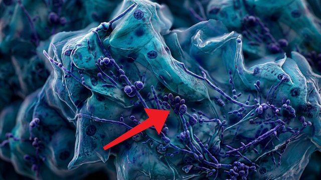 Video thumbnail: Herpes, trichomonas, yeast, vaginosis .. your Pap test detects more than cancer