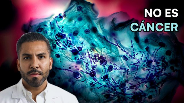 Video thumbnail: Herpes, trichomonas, yeast, vaginosis .. your Pap test detects more than cancer