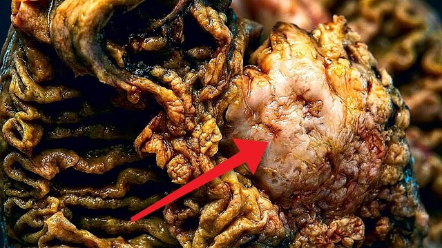 Video thumbnail: Pancreatic cancer: the pill that finally doubled survival