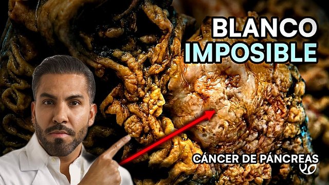 Video thumbnail: Pancreatic cancer: the pill that finally doubled survival