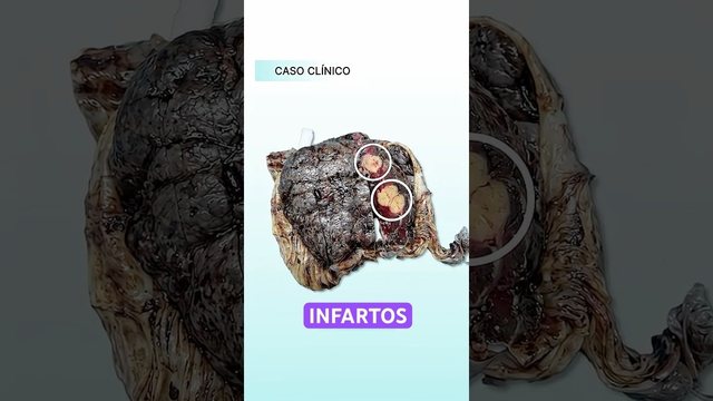 Video thumbnail: This placenta has infarcts .. this is how preeclampsia works from the inside