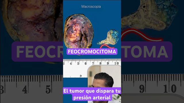 Video thumbnail: Pheochromocytoma
