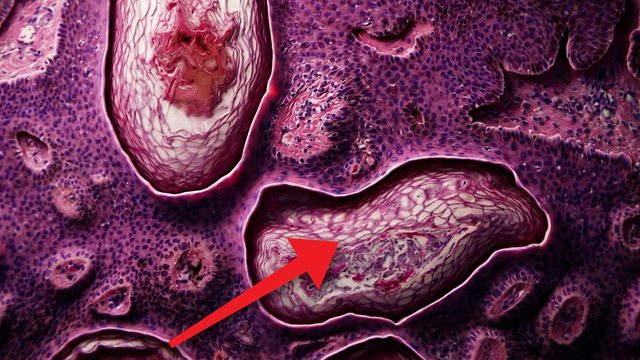 Video thumbnail: A spot on the skin kept growing and bleeding .. this is what we found under the microscope