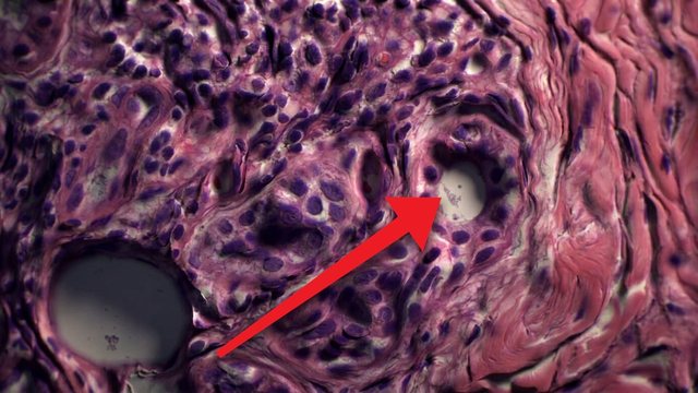 Video thumbnail: Syphilis: the infection that disguises itself as almost any disease