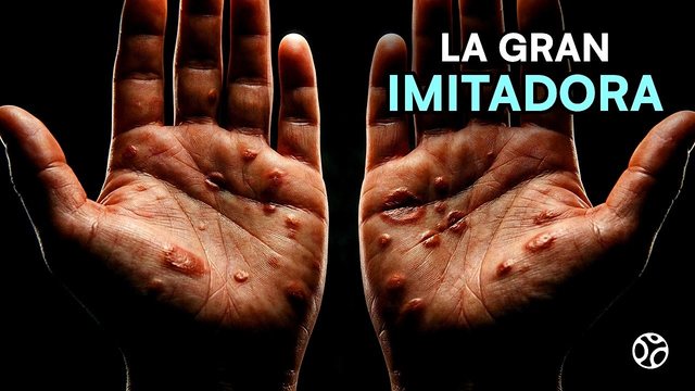 Video thumbnail: Syphilis: the infection that disguises itself as almost any disease