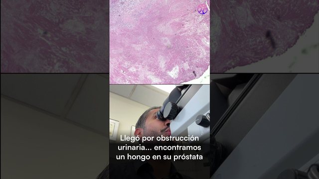Video thumbnail: He came in with a urinary obstruction .. and we found a fungus in his prostate