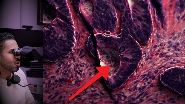 Video thumbnail: They found several tumors in his liver .. but the cancer started somewhere else
