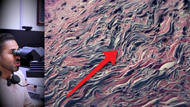 Video thumbnail: A squamous lesion that looked like nothing .. how the sun turns it into cancer