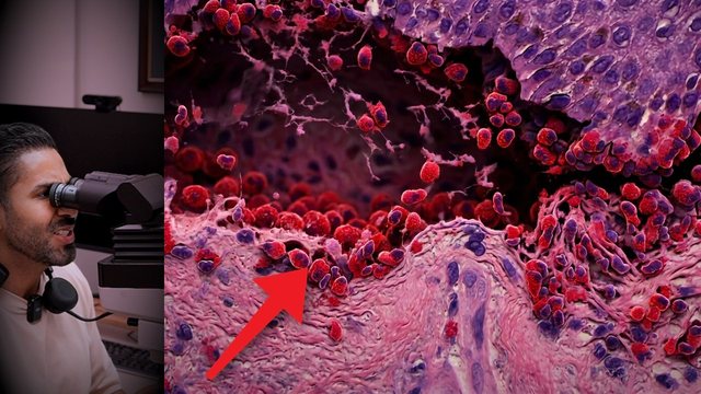 Video thumbnail: Months of itching and blisters all over the body .. and it was not an allergy