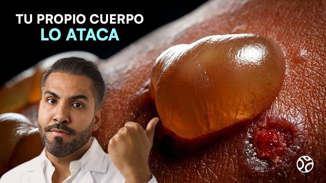 Video thumbnail: Months of itching and blisters all over the body .. and it was not an allergy