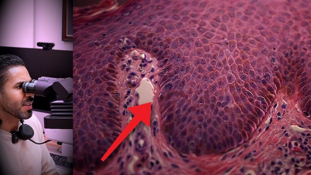 Video thumbnail: Psoriasis: why your skin flakes and bleeds when you scratch it