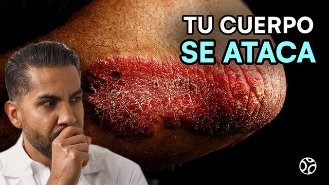 Video thumbnail: Psoriasis: why your skin flakes and bleeds when you scratch it