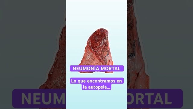 Video thumbnail: Fatal pneumonia: what we found at autopsy