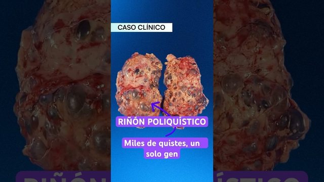 Video thumbnail: Your kidneys can grow to weigh 10 kilograms