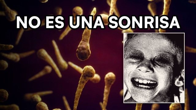 Video thumbnail: Tetanus: the smile no doctor wants to see