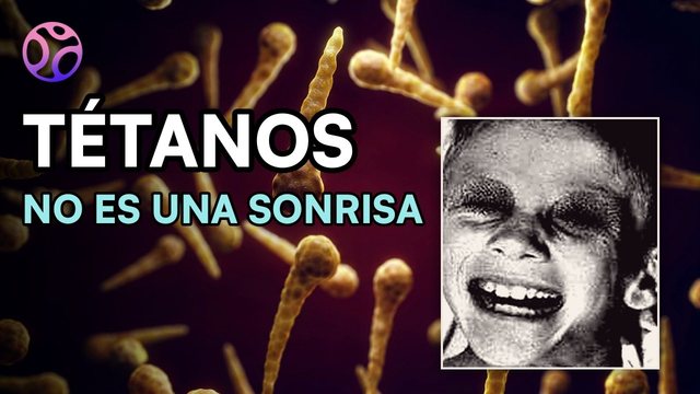 Video thumbnail: Tetanus: the smile no doctor wants to see