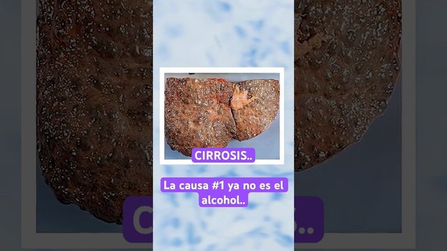 Video thumbnail: Cirrhosis: the leading cause is no longer alcohol