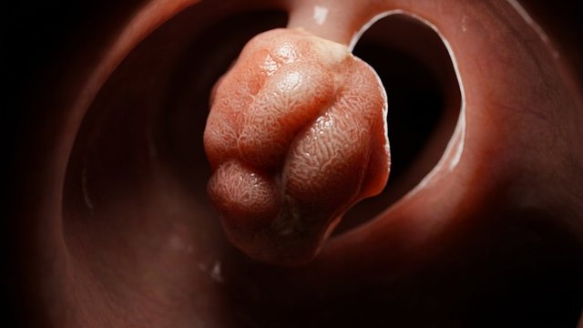 Video thumbnail: A colonoscopy with no symptoms... and this is what they found | COLON POLYP