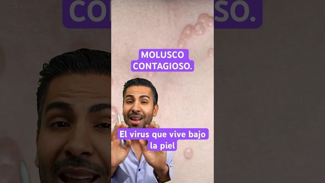 Video thumbnail: Molluscum contagiosum: the virus that hides in the skin