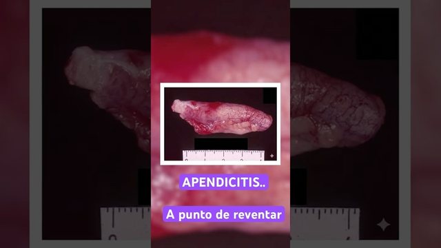 Video thumbnail: This appendix is about to rupture
