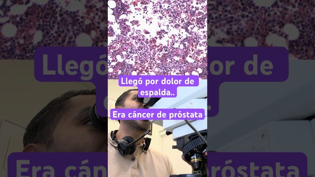 Video thumbnail: His prostate cancer traveled all the way to his vertebrae