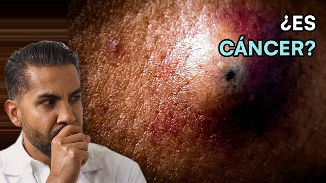 Video thumbnail: He was worried about skin cancer .. this is what it actually was